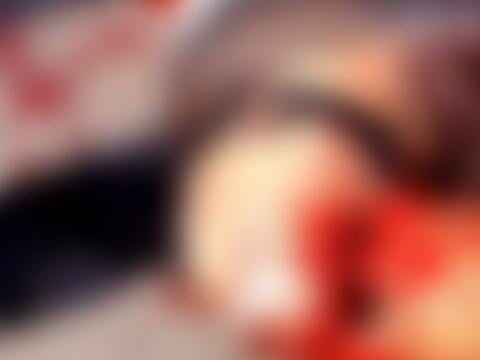 Acidente em Caicó deixa vítima com risco de perder a perna após ser atingida por carro