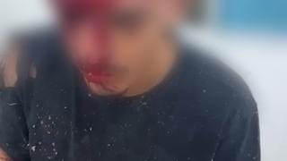 Jovem aparece ferido no hospital após grave acidente entre Ipanguaçu e Alto do Rodrigues, no RN