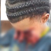 Jovem tem rosto desfigurado após ser atingido por espada junina em Salvador (BA)